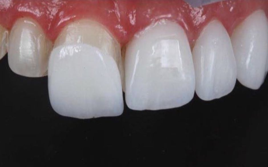 lente dental (940 × 587 px) (4)