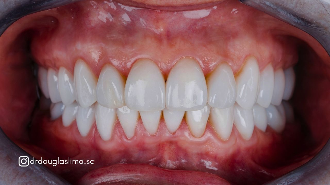blogpost diferença entre lente e faceta dental dr douglas lima (1)